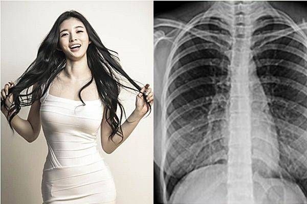 Mẫu Hàn tung phim X-quang chứng minh ngực thật
