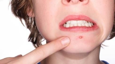 Có hay không chuyện tử vong vì nặn mụn?