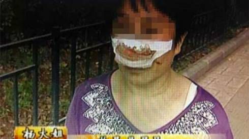 Bị chồng cắn đứt lìa mũi vì không nghe điện thoại