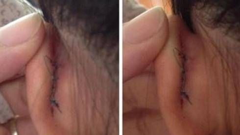 Học sinh bị cô giáo véo đứt tai vì viết chậm