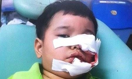 Bé trai 3 tuổi bị chó cắn nát mặt phải khâu 200 mũi