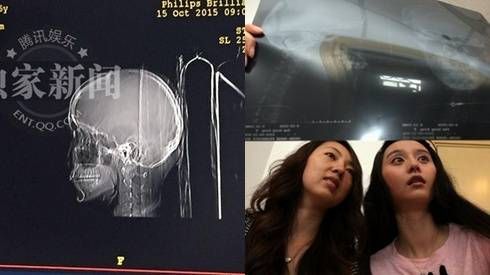 3 giai nhân Hoa ngữ minh oan tin đồn thẩm mỹ nhờ chụp cắt lớp