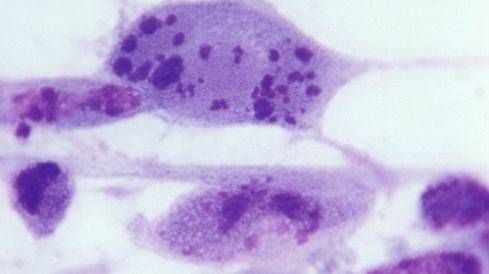 2/3 dân số thế giới nhiễm virus lây qua đường tình dục