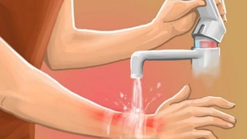 Nguy hại khó lường từ việc rắc bột kháng sinh lên vết bỏng