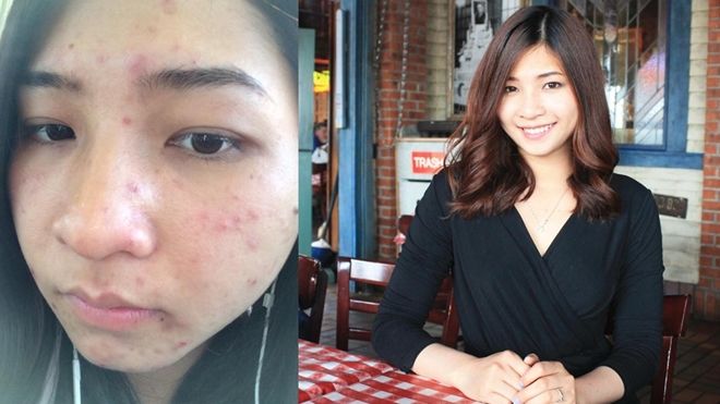 Học Giang Thuỳ cách trị da mặt dị ứng, khô và nổi mụn do thời tiết