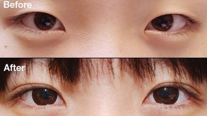 Xu hướng phẫu thuật thẩm mỹ thịnh hành nhất Hàn Quốc