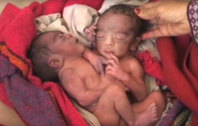 Vợ chồng trẻ giành giật sự sống cho cặp song sinh 2 đầu, 4 tay, 2 chân