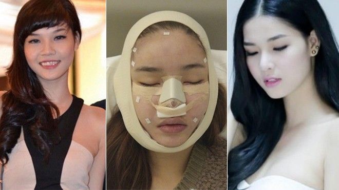 Loạt sao Việt lộ ảnh băng bó khi phẫu thuật thẩm mỹ khiến khán giả sốc