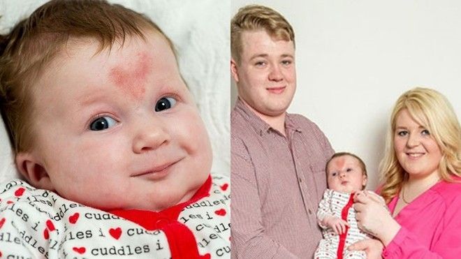 Em bé thụ thai đúng Valentine's day sinh ra với vết bớt hình trái tim trên mặt