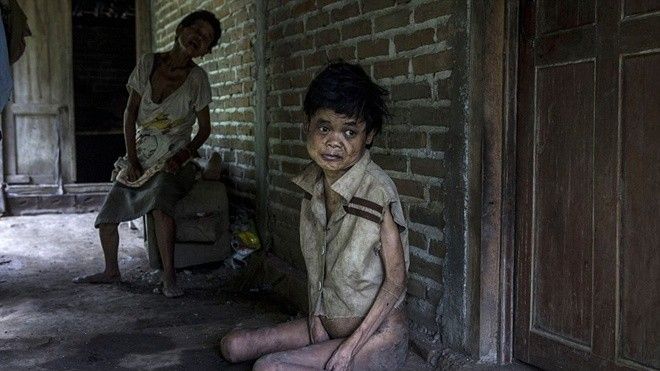 Ám ảnh những ánh mắt ngây dại tại các làng 'địa ngục' ở Indonesia