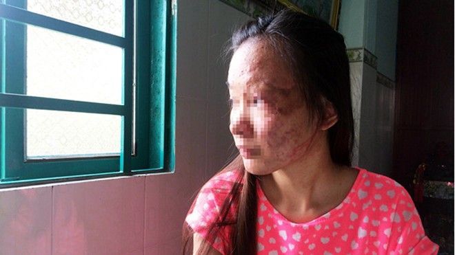 Nữ sinh viên bị tạt axit: Nỗi đau ở lại mãi mãi trên khuôn mặt