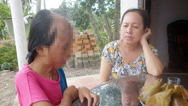 Đau xót với thương tích nặng nề của cô gái miền Tây bị tạt axit vì mẹ ngoại tình