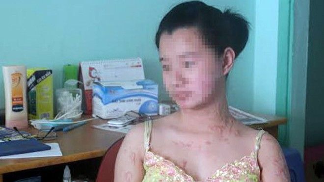 Cuộc sống tăm tối của 2 cô gái bị tạt axít ở Sài Gòn