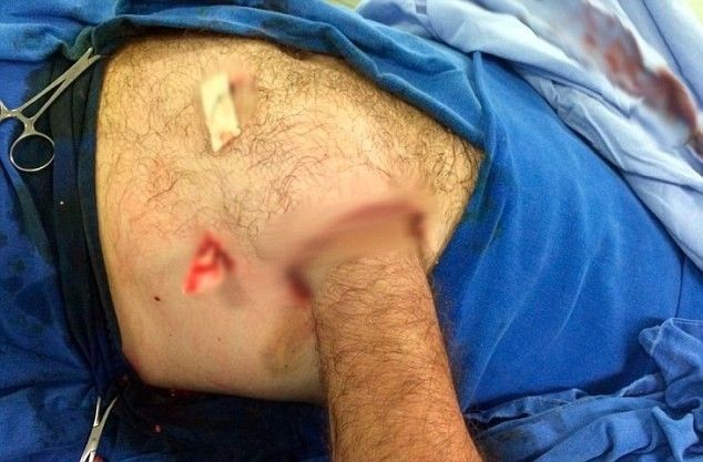 Bác sỹ quyết cứu bàn tay bị lột da bằng cách nhét vào … ổ bụng