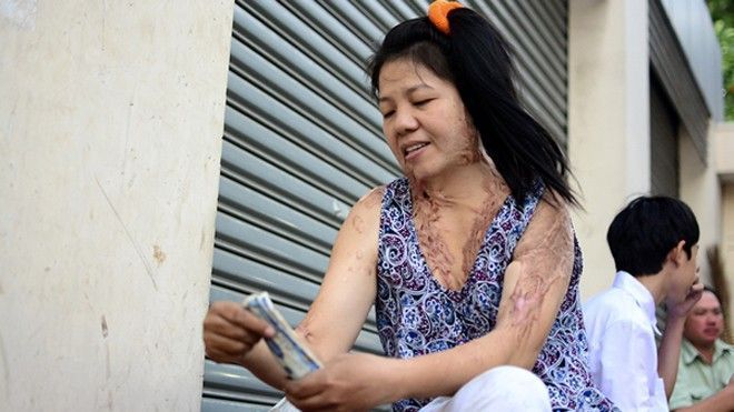 Nghị lực sống mạnh mẽ của người phụ nữ bị tạt axit ở Sài Gòn ba năm trước