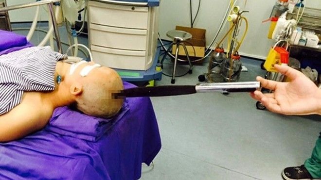 Bố chồng làm rơi dao nhọn giữa đỉnh đầu con dâu mang thai