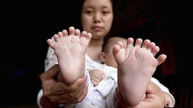 Chạy vạy khắp nơi cầu cứu bác sĩ vì sinh con có 15 ngón tay và 16 ngón chân