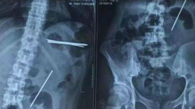 Cái kết đắng của màn thể hiện bản lĩnh 'ruột thép' trước mặt bạn gái