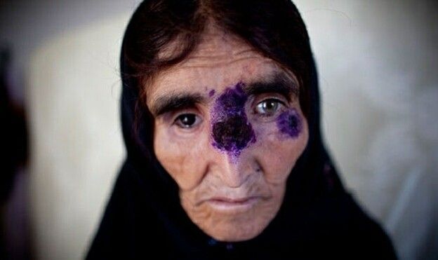 Vi khuẩn 'ăn thịt người' gieo rắc nỗi kinh hoàng cho nhân loại 