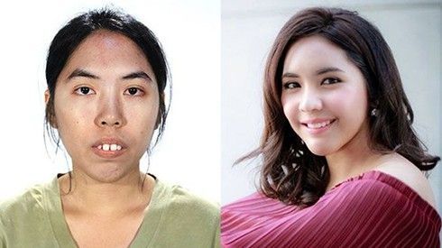 Những cô gái này sẽ 'không sống nổi' nếu thiếu phẫu thuật thẩm mỹ