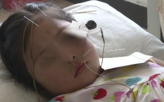 Cảnh báo trẻ em bị méo mồm, liệt mặt do nằm điều hòa sai cách