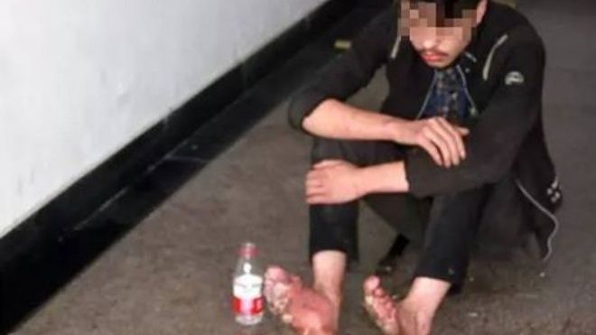 Thối rữa cả bàn chân vì mải mê 'cày' game trực tuyến