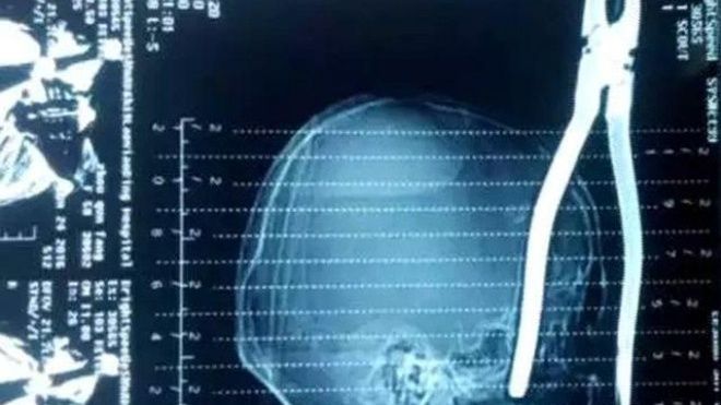Hy hữu: Gọng kìm rơi trúng đầu cắm sâu 15cm, nạn nhân tỉnh táo đợi xe cứu thương