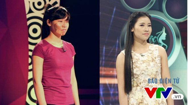 Cận cảnh quá trình phẫu thuật thẩm mỹ xóa vết chàm của cô gái dân tộc