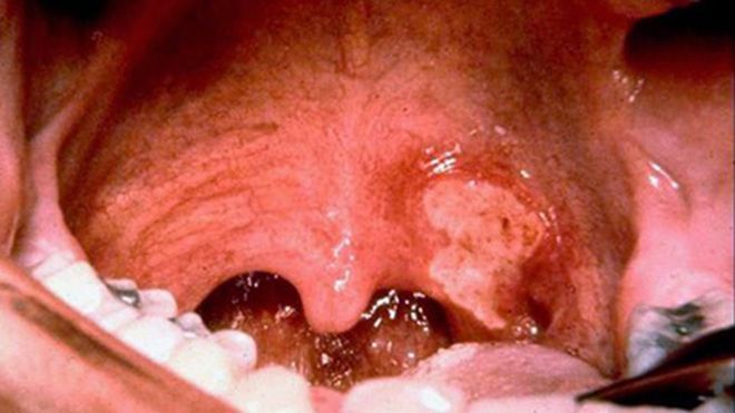 Những con số kinh hoàng về dịch bệnh bạch hầu