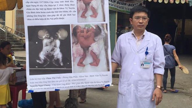 Bác sĩ ra chợ xin từ thiện cứu 2 bé song sinh dính liền: Bị trách nhưng vẫn vui