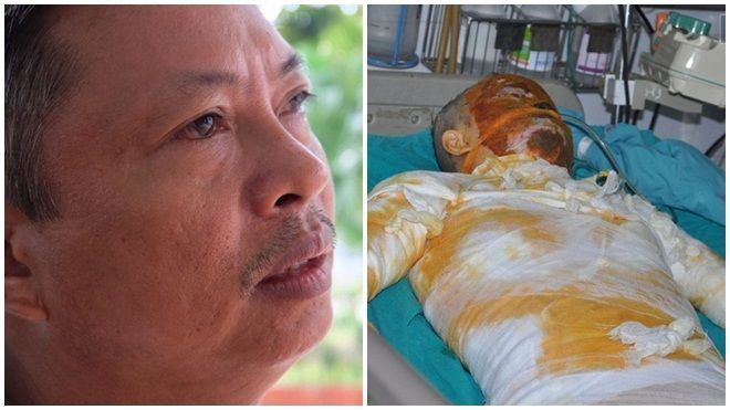 Cô gái xinh đẹp bị bỏng nặng: 'Sợ cụt hết tay, thành dị dạng không ai dám đến gần'