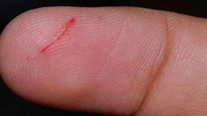 Tử vong vì một vết xước ở tay: Cảnh báo căn bệnh 'giết' nhiều người hơn cả ung thư và AIDS
