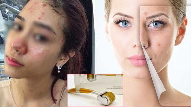 Tự lăn kim tại nhà, có nên hay không và phải làm thế nào mới đúng?