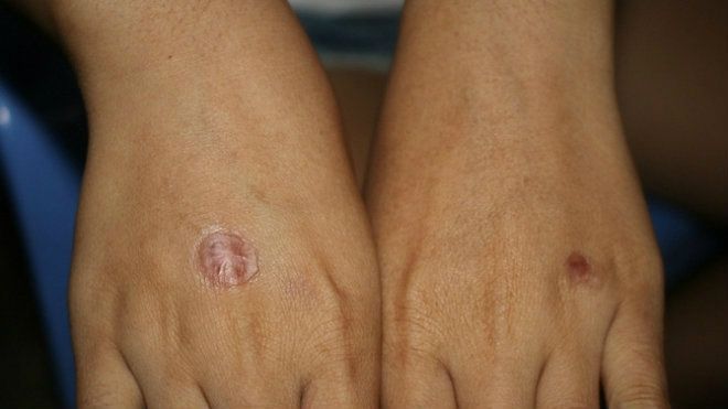 Nữ sinh run sợ kể phút bị bạn châm thuốc lá vào tay, bắt liếm chân