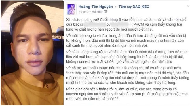 Hoàng Tôn cầu cứu cộng đồng mạng vì gương mặt lỗi sau thẩm mỹ
