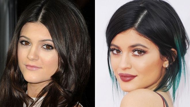Không phải cứ tiêm môi là sẽ thành Kylie Jenner đâu nhé các nàng!
