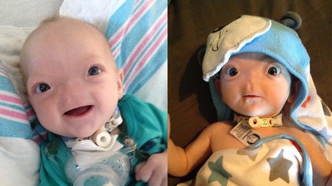 Dù không có mũi, nhưng cậu bé này vẫn được bình chọn là 'em bé có gương mặt đáng yêu nhất' trên Facebook