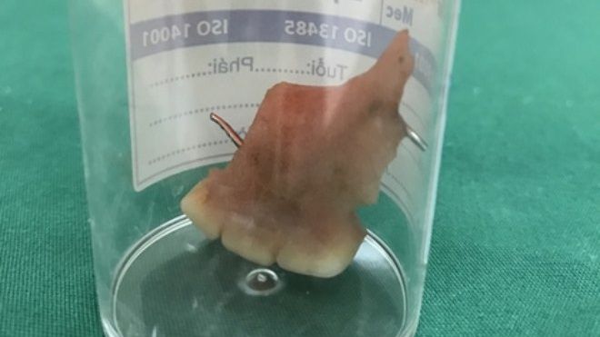 Nam thanh niên lỡ nuốt 3 chiếc răng giả vì 'vui quá đà' trong tiệc cưới