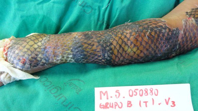 Kinh ngạc với phương pháp chữa bỏng bằng da cá rô phi