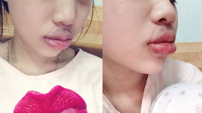 Cô nàng nhận 'trái đắng' vì dại dột làm đẹp theo phương pháp này