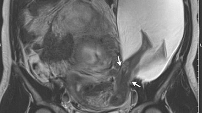 Thai nhi siêu quậy đạp rách cả dạ con của mẹ để thò chân ra ngoài