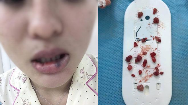 Bơm môi hình trái tim, cô gái trẻ phải gắp bỏ 18 'dị vật' như viên bi bên trong môi