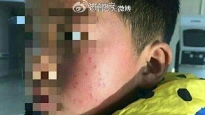 Hiệu trưởng trường tiểu học dùng bút bi đâm 17 nhát vào mặt học sinh