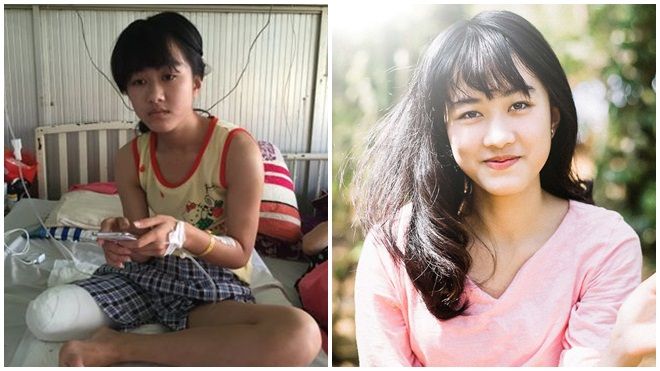 Nữ sinh bị cưa chân do tắc trách của bác sĩ và thành tích tuyệt vời 1 năm sau sự cố