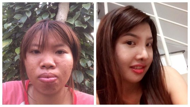 Diện mạo mới của bà mẹ đơn thân ở Đắk Nông quyết đi phẫu thuật vì quá xấu