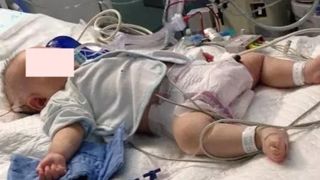 Uống sữa công thức đặc hơn tiêu chuẩn, bé sơ sinh 1 tháng phải… cắt ruột