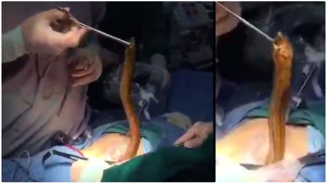 Nuôi lươn dài nửa mét trong bụng, người đàn ông khiến bác sĩ hoảng hồn vì kết quả thu được sau cuộc phẫu thuật