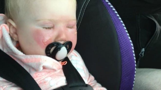 Dùng kem chống nắng cho con gái 14 tháng tuổi, mẹ trẻ tá hoả khi con bị bỏng dù không chơi dưới nắng