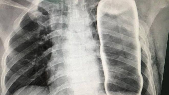 Hy hữu: Phát hiện vỏ chai thủy tinh chui tọt trong lồng ngực một người đàn ông ở Quảng Nam