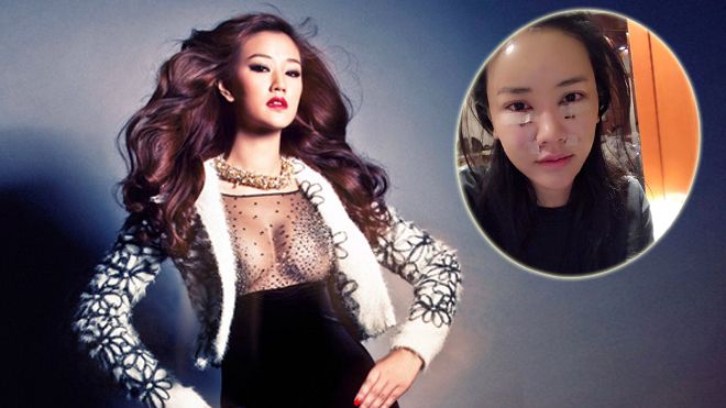 Maya mặt sưng phù sau khi đi phẫu thuật thẩm mỹ tại Hàn Quốc